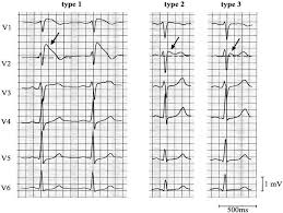 How the camel got his hump kipling's story. Brugada Syndrome Litfl Ecg Library Diagnosis