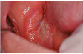 Image result for spinocellular carcinoma of the oral cavity