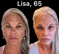 Before & after treatment. Further Elen Baron Amsterdam, Netherlands Belgium  Maria Kenig Marie-Chantal Weber Míkonos Utrecht, Netherlands Konstantinos  Panagopoulos Malta Ekáli, Greece Learn Italian with Ines #italy #milano  #rome #Lambardia Pisa, Italy #