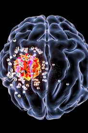Children can develop the same mental health conditions as adults, but their symptoms may be different. Deadly Brain Cancer Stopped With New Compound