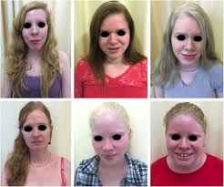 Maybe you would like to learn more about one of these? Albinism Epidemiology Genetics Cutaneous Characterization Psychosocial Factors Sciencedirect