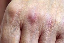 Dactarbari The first symptom of dermatomyositis is a skin rash that may come before or with the muscle weakness.
