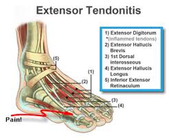 Extensor tendons connect muscle to bone and are located just under the skin. Log Injuries 26miles2013