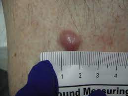 Merkel cell carcinoma (mcc) is a rare skin cancer that often looks harmless. Merkel Cell Carcinoma Case Study And Literature Review Sciencedirect