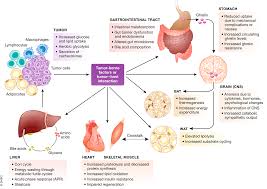 Image result for Cachexia in Cancer