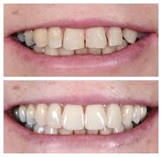 How long do veneers last? A Complete Guide To Dental Veneers Docklands Dental