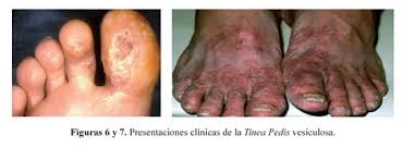 Image result for Tinnea vesiculosa