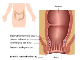 Image result for Hemorrhoid