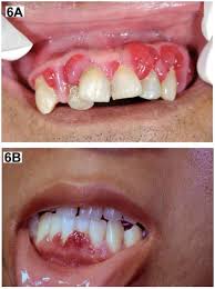 Image result for granuloma gum disease