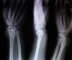Distal Radius Kiriklari Kirik El Bilekligi Colles Kirigi Dora Hospital
