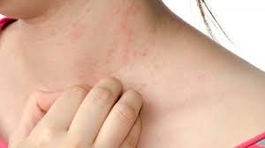 Cosa sono le intossicazioni alimentari? Dermatite Da Stress I Sintomi E Le Cure