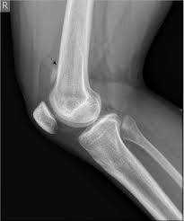 Image result for periostitis