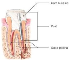Root canal treatment is usually carried out under local anaesthetic, a painkilling medicine that numbs your infected tooth and the gum around it. Root Canal Explained American Association Of Endodontists