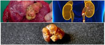 What Is Nephrolithiasis Symptoms Causes And Treatment Hoool Health Wellness