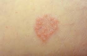 Granuloma annulare is a skin disorder that caused raised lesions on the hands and feet. Granuloma Annulare What Are The Main Causes Techicy