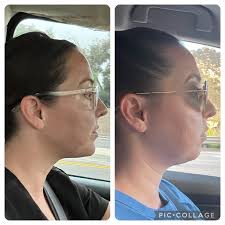 Has anyone had any recent surgeries with Dr. Dale Stringer from Riverside?  : r/jawsurgery