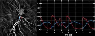 Image result for Extrasystole