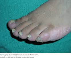 Image result for Onychogryphosis feet