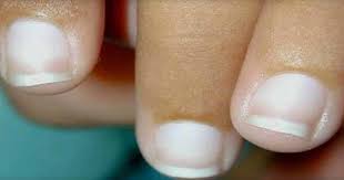 nails what are the causes symptoms