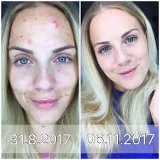 Wenn du dir die frage stellst, wann du am besten die pille absetzen solltest, gibt es verschiedene situationen, in denen du dich befinden kannst: Facebook