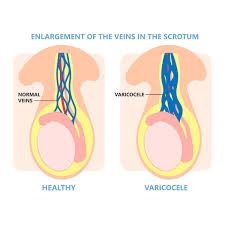 Image result for Varicocele