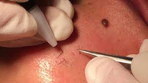 There's a noticeable difference in regrowth rates before and after electrolysis. Electrolysis Hair Removal For Transgender Women 2pass Clinic