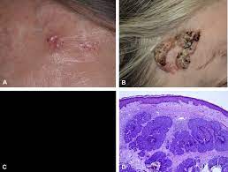 Learn how each type differs. Basal Cell Carcinoma Journal Of The American Academy Of Dermatology