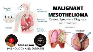 In this article, we&#x27;ll cover: Mesothelioma Malignant Pleura Cause Diagnosis Symptoms Treatment Edulesson