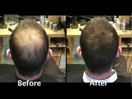 Image result for hair los product