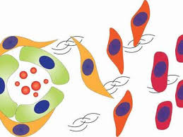 5 ﻿ however, a 2017 study found survival rates for those with stage 4 colon cancer that metastasized to the liver and were candidates for removal of the liver metastases at the same time as colon surgery improved to up to 70% 6 ﻿. Metastatic Colorectal Cancer May Spread Early National Cancer Institute