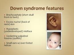 Newborn Down Syndrome Baby Features Newborn Baby