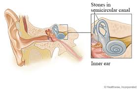 Home > common ear conditions > vertigo and the inner ear. Benign Paroxysmal Positional Vertigo Bppv Care Instructions