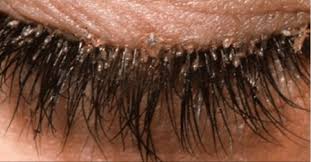 What Are Eyelash Mites Woman Suffers Redness In Eyes Due To Parasites Eyelash Mites Eye Mites Eyelashes