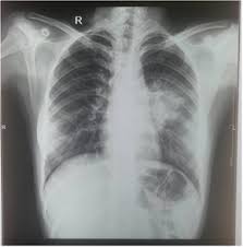 X Ray Chest Showing Inhomogeneous Opacity In The Middle Zone Of Left Lung Download Scientific Diagram