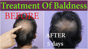 Coconut oil, argan oil, jojoba oil, sweet almond oil, olive oil, grapeseed oil. Best Hair Regrowth Herbal Oil By Herbhair For Baldness Or Alopecia Youtube