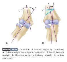 Image result for Lateral Condyle Fracture