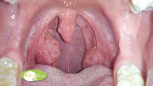 Image result for Peritonsillar Abscess