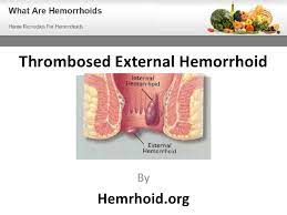 These occurs when a blood clot develops in a hemorrhoidal blood vessel causing. Thrombosed External Hemorrhoid