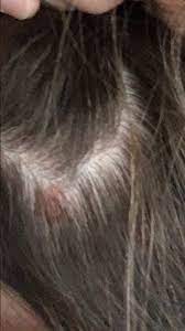 Roter Knubbel Am Hinterkopf Kopf