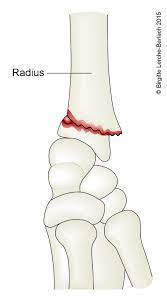 Handgelenkfraktur Deximed