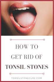 Pin On Tonsil Stone Cures