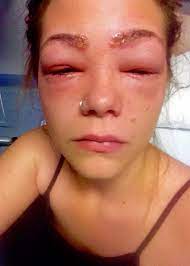 Contact dermatitis can occur on the chest and shoulder region also. Teen S Boxed Hair Dye Experiment Causes Severe Allergic Reaction Allure