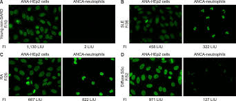 Image result for ANA Staining Pattern