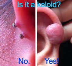 Piercing Bump: 6 Ways To Get Rid Of Cartilage Or Nose Keloid, Blister