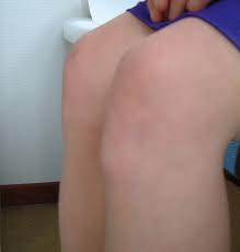Morbus Osgood Schlatter
