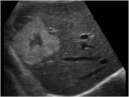 Hemangioma Ultrasound Sonography Diagnostic Medical Sonography Ultrasound