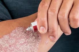 Image result for psoriasis