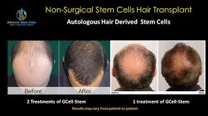 Stem cell therapy india takes pride in treating many successful businessmen, celebs and many popular personalities including politicians and sportsman. The Stem Cell Hair Transplant May Change The Future Of Hair Restoration Youtube