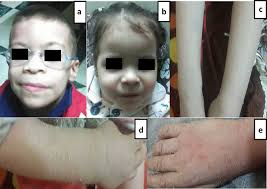 Clinical phenotype of patients: a and b Faces of patient 3 and 4...