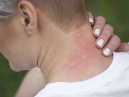 Insect Sting Allergy Basics What Are Allergies